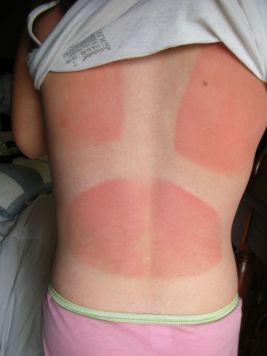 sunburn affected